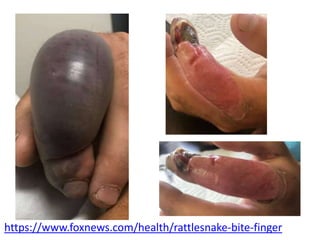 https://www.foxnews.com/health/rattlesnake-bite-finger
 