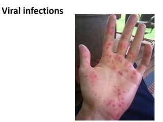 Viral infections
 