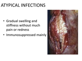ATYPICAL INFECTIONS
• Gradual swelling and
stiffness without much
pain or redness
• Immunosuppressed mainly
 