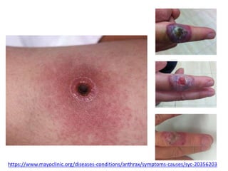 https://www.mayoclinic.org/diseases-conditions/anthrax/symptoms-causes/syc-20356203
 
