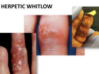 HERPETIC WHITLOW
 