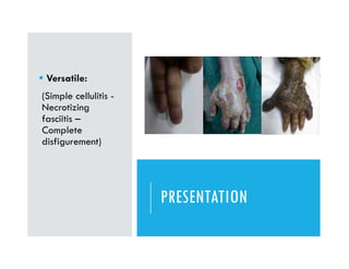 PRESENTATION
 Versatile:
(Simple cellulitis -
Necrotizing
fasciitis –
Complete
disfigurement)
 