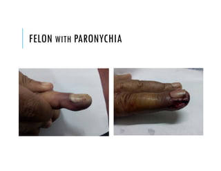 FELON WITH PARONYCHIA
 