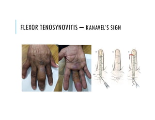 FLEXOR TENOSYNOVITIS – KANAVEL’S SIGN
 