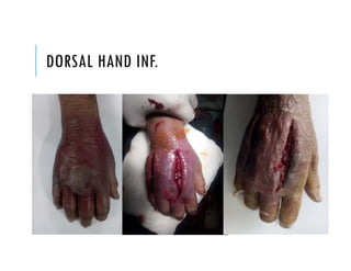 DORSAL HAND INF.
 
