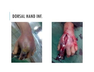 DORSAL HAND INF.
 