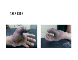 SELF BITE
 