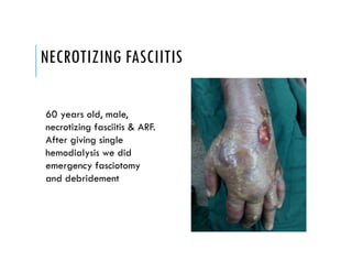 NECROTIZING FASCIITIS
60 years old, male,
necrotizing fasciitis & ARF.
After giving single
hemodialysis we did
emergency fasciotomy
and debridement
 