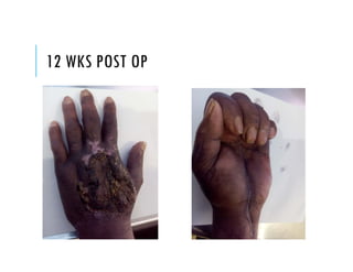 12 WKS POST OP
 