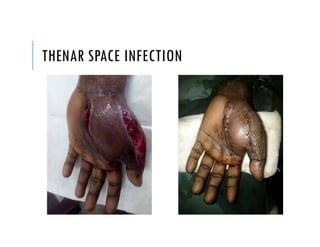 THENAR SPACE INFECTION
 