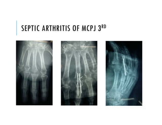 SEPTIC ARTHRITIS OF MCPJ 3RD
 
