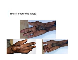 FINALLY WOUND WAS HEALED
 