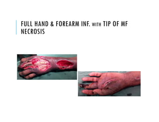 FULL HAND & FOREARM INF. WITH TIP OF MF
NECROSIS
 