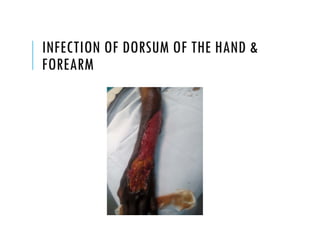 INFECTION OF DORSUM OF THE HAND &
FOREARM
 