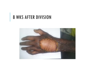 8 WKS AFTER DIVISION
 