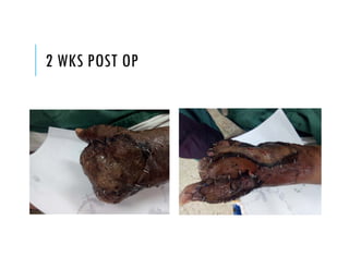 2 WKS POST OP
 