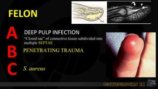 FELON
DEEP PULP INFECTION
A
PENETRATING TRAUMA
S. aureus
B
C
“Closed sac” of connective tissue subdivided into
multiple SEPTAE
 