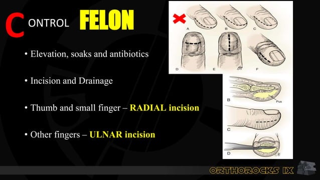 COMMON HAND INFECTION ORTHO SURGERY pptx COMMON HAND INFECTION ORTHO SURGERY pptx