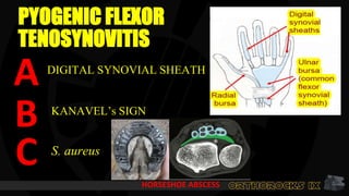 PYOGENIC FLEXOR
TENOSYNOVITIS
A
KANAVEL’s SIGN
S. aureus
B
C
DIGITAL SYNOVIAL SHEATH
HORSESHOE ABSCESS
 