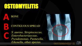 OSTEOMYELITIS
A
CONTIGUOUS SPREAD
S. aureus, Streptococcus,
Enterobacteriaeceae,
Pseudomonas, Pasturella,
Eikenella, other species
B
C
BONE
 