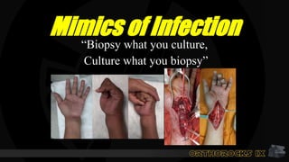 Mimics of Infection
“Biopsy what you culture,
Culture what you biopsy”
 