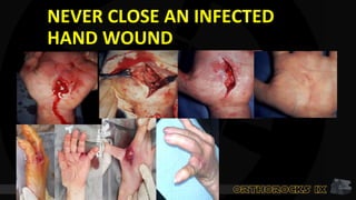 NEVER CLOSE AN INFECTED
HAND WOUND
 