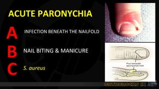 ACUTE PARONYCHIA
INFECTION BENEATH THE NAILFOLD
A
NAIL BITING & MANICURE
S. aureus
B
C
 