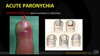 ACUTE PARONYCHIA
HYPONYCHIUM- most resistant to infection
 