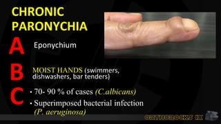 CHRONIC
PARONYCHIA
Eponychium
A
MOIST HANDS (swimmers,
dishwashers, bar tenders)
• 70- 90 % of cases (C.albicans)
• Superimposed bacterial infection
(P. aeruginosa)
B
C
 
