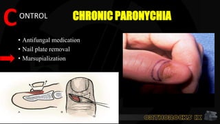 CHRONIC PARONYCHIA
• Antifungal medication
• Nail plate removal
• Marsupialization
CONTROL
 