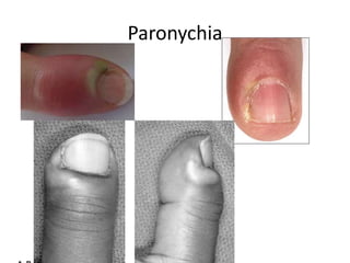 Paronychia 
 
