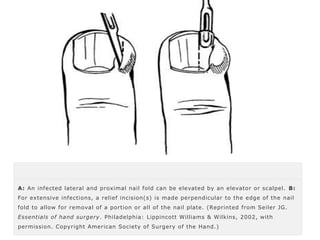 A: An infected lateral and proximal nail fold can be elevated by an elevator or scalpel. B: 
For extensive infections, a relief incision(s) is made perpendicular to the edge of the nail 
fold to allow for removal of a portion or all of the nail plate. (Reprinted from Seiler JG. 
Essentials of hand surgery. Philadelphia: Lippincott Williams & Wilkins, 2002, with 
permission. Copyright American Society of Surgery of the Hand.) 
 