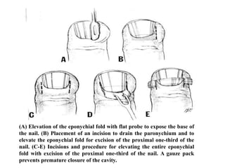 (A) Elevation of the eponychial fold with flat probe to expose the base of 
the nail. (B) Placement of an incision to drain the paronychium and to 
elevate the eponychial fold for excision of the proximal one-third of the 
nail. (C-E) Incisions and procedure for elevating the entire eponychial 
fold with excision of the proximal one-third of the nail. A gauze pack 
prevents premature closure of the cavity. 
 