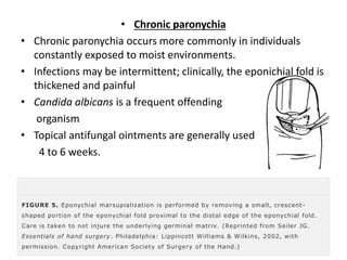 • Chronic paronychia 
• Chronic paronychia occurs more commonly in individuals 
constantly exposed to moist environments. 
• Infections may be intermittent; clinically, the eponichial fold is 
thickened and painful 
• Candida albicans is a frequent offending 
organism 
• Topical antifungal ointments are generally used 
4 to 6 weeks. 
FIGURE 5. Eponychial marsupialization is performed by removing a small, crescent - 
shaped portion of the eponychial fold proximal to the distal edge of the eponychial fold. 
Care is taken to not injure the underlying germinal matrix. (Reprinted from Seiler JG. 
Essentials of hand surgery. Philadelphia: Lippincott Williams & Wilkins, 2002, with 
permission. Copyright American Society of Surgery of the Hand.) 
 