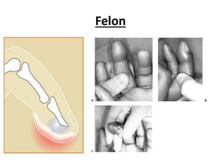 Felon 
 