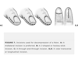 FIGURE 7. Incisions used for decompression of a felon. A: A 
midlateral incision is preferred. B: A J-shaped or hockey-stick 
incision. C: A through-and-through incision. D,E: A volar transverse 
or longitudinal incision. 
 