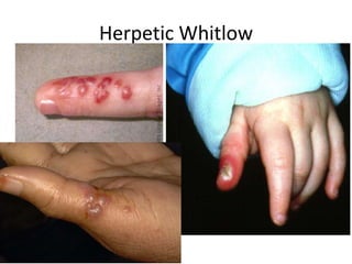 Herpetic Whitlow 
 