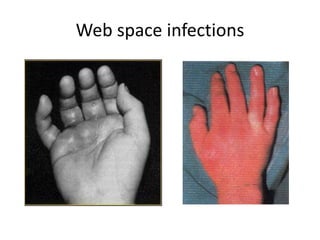 Web space infections 
 