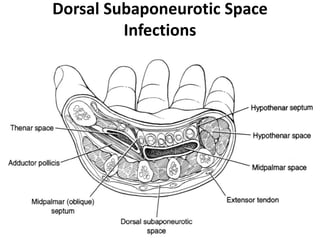 Dorsal Subaponeurotic Space 
Infections 
 