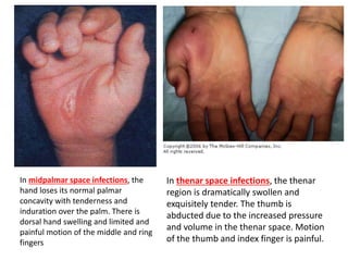In midpalmar space infections, the 
hand loses its normal palmar 
concavity with tenderness and 
induration over the palm. There is 
dorsal hand swelling and limited and 
painful motion of the middle and ring 
fingers 
In thenar space infections, the thenar 
region is dramatically swollen and 
exquisitely tender. The thumb is 
abducted due to the increased pressure 
and volume in the thenar space. Motion 
of the thumb and index finger is painful. 
 