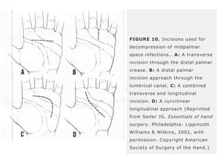 FIGURE 10. Incisions used for 
decompression of midpalmar 
space infections.. A: A transverse 
incision through the distal palmar 
crease. B: A distal palmar 
incision approach through the 
lumbrical canal. C: A combined 
transverse and longitudinal 
incision. D: A curvilinear 
longitudinal approach (Reprinted 
from Seiler JG. Essentials of hand 
surgery. Philadelphia: Lippincott 
Williams & Wilkins, 2002, with 
permission. Copyright American 
Society of Surgery of the Hand.) 
 