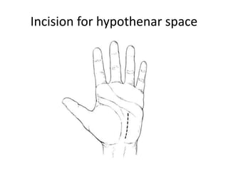 Incision for hypothenar space 
 