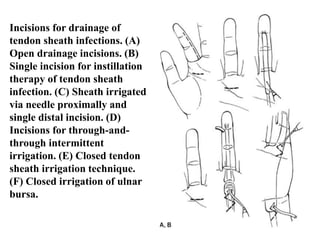Incisions for drainage of 
tendon sheath infections. (A) 
Open drainage incisions. (B) 
Single incision for instillation 
therapy of tendon sheath 
infection. (C) Sheath irrigated 
via needle proximally and 
single distal incision. (D) 
Incisions for through-and-through 
intermittent 
irrigation. (E) Closed tendon 
sheath irrigation technique. 
(F) Closed irrigation of ulnar 
bursa. 
 