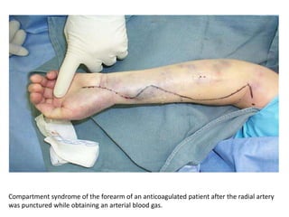 Compartment syndrome of the forearm of an anticoagulated patient after the radial artery 
was punctured while obtaining an arterial blood gas. 
 