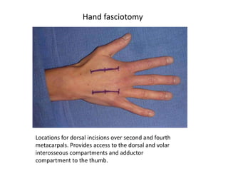 Hand fasciotomy 
Locations for dorsal incisions over second and fourth 
metacarpals. Provides access to the dorsal and volar 
interosseous compartments and adductor 
compartment to the thumb. 
 