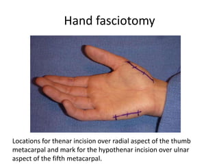 Hand fasciotomy 
Locations for thenar incision over radial aspect of the thumb 
metacarpal and mark for the hypothenar incision over ulnar 
aspect of the fifth metacarpal. 
 