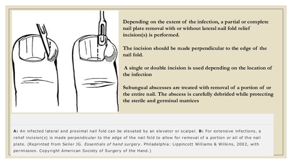Hand infections