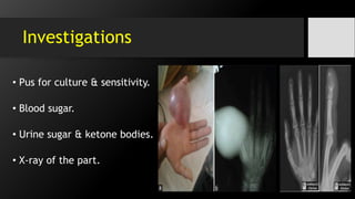 Investigations
• Pus for culture & sensitivity.
• Blood sugar.
• Urine sugar & ketone bodies.
• X-ray of the part.
 