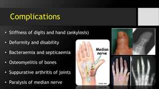 Complications
• Stiffness of digits and hand (ankylosis)
• Deformity and disability
• Bacteraemia and septicaemia
• Osteomyelitis of bones
• Suppurative arthritis of joints
• Paralysis of median nerve
 