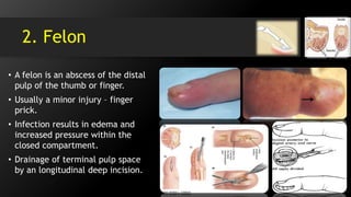 2. Felon
• A felon is an abscess of the distal
pulp of the thumb or finger.
• Usually a minor injury – finger
prick.
• Infection results in edema and
increased pressure within the
closed compartment.
• Drainage of terminal pulp space
by an longitudinal deep incision.
 